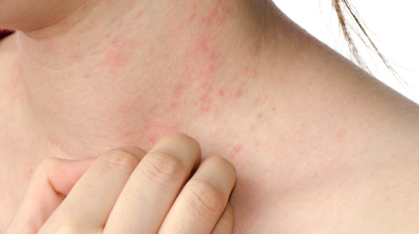 Kış mevsiminde cilt hastalıkları artıyor