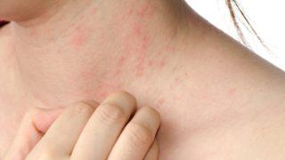 Kış mevsiminde cilt hastalıkları artıyor