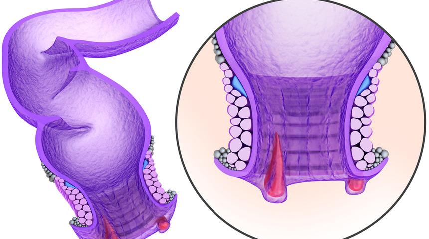 Makat çatlağında sıvı tüketimi nasıl olmalı?