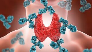 Hashimoto hastalığı belirtileri ve tedavisi nedir?