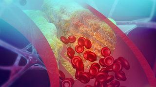 Damar tıkanıklığına iyi gelen bitkisel karışımlar ölüme neden oluyor!