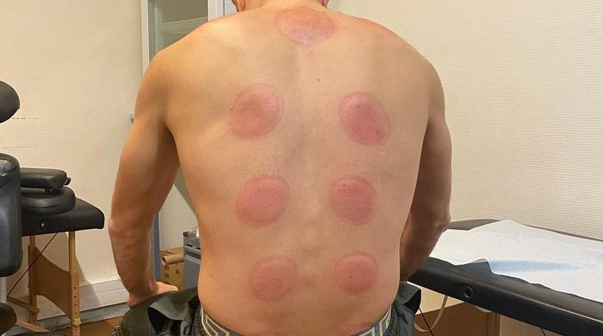 Benzema, hacamat yaptırdı