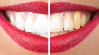 Hayalini kurduğunuz bembeyaz dişlere sahip olmak çok kolay! Muz, portakal…