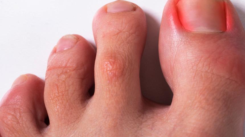 Bunları uygulamazsanız ömür boyu tırnak batması ile yaşamanız gerekebilir! Hemen gerekeni yapmak için...