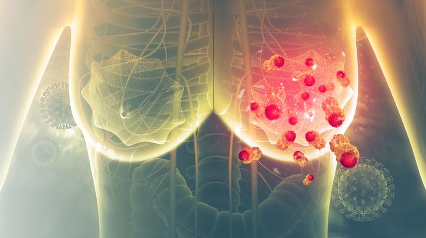 Meme kanseri tedavisinde tek çare kemoterapi değil! 