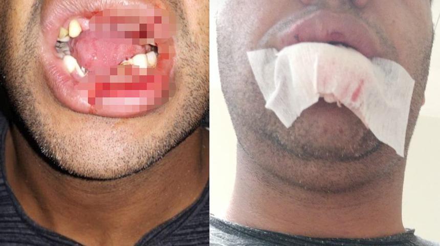 Şap aşısı yapmaya çalıştığı inekten tekme yiyen veterinerin çenesi kırıldı