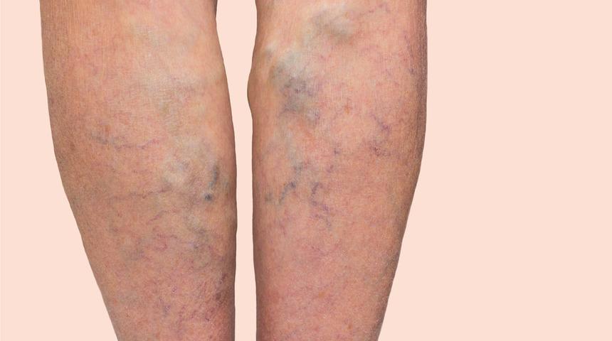 Varis tedavisi ertelenirse ne olur?