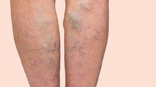 Varis tedavisi ertelenirse ne olur?