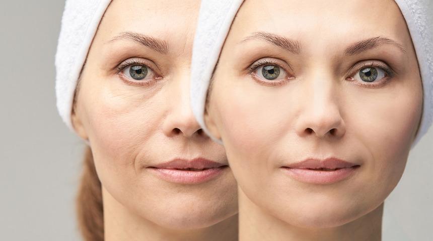 Yüzdeki yorgun görünüm göz altı ışık dolgusu ile yok oluyor