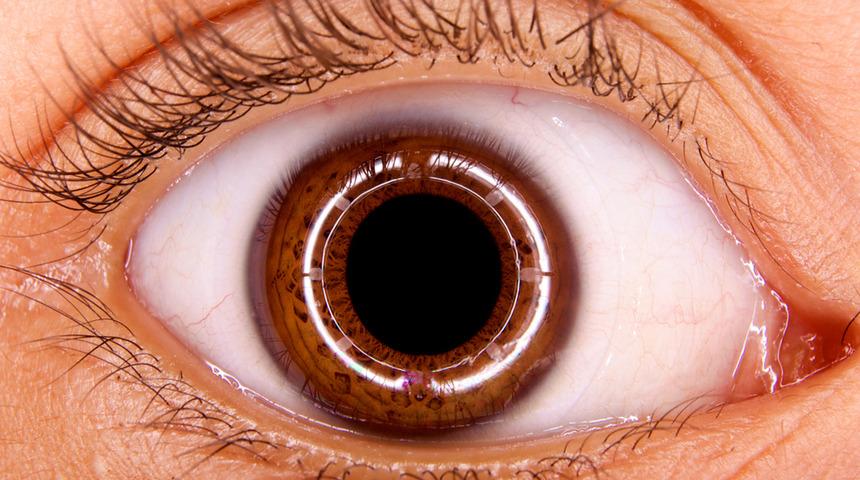 Gözyaşı kanalı tıkanıklığı tedavisi ve belirtileri neler?