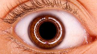 Gözyaşı kanalı tıkanıklığı tedavisi ve belirtileri neler?