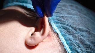 Kepçe kulak ameliyatı ile istenilen görünüme kavuşmak mümkün