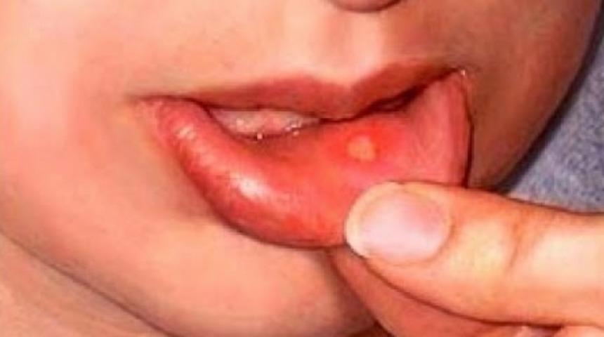 Aft neden oluşur? Tedavisi nedir?