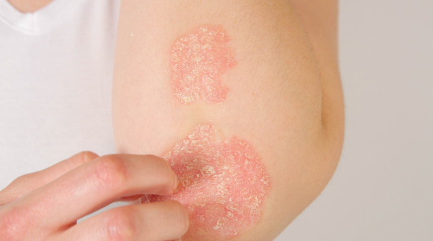 Kronik egzama sorunu olanlar buraya! Bu yöntemleri uygularsanız...