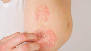 Kronik egzama sorunu olanlar buraya! Bu yöntemleri uygularsanız...