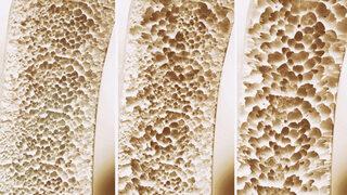 Osteoporoz nedir, kemik erimesi belirtileri nelerdir? 