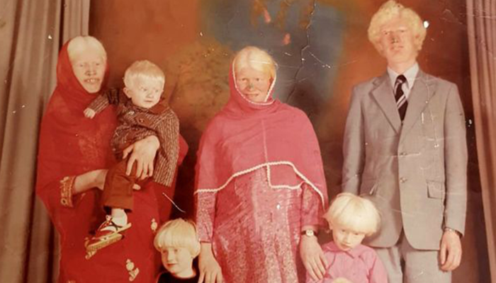 Guinness rekortmeni olmuşlardı! Dünyanın en büyük albino ailesi taciz ve ev saldırılarına uğradığını itiraf etti