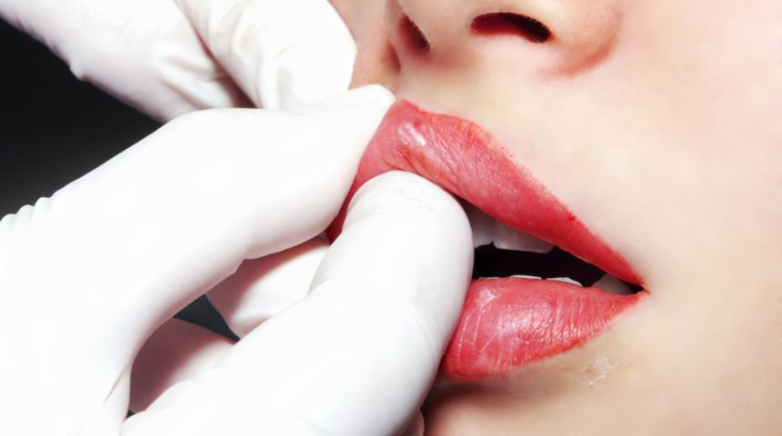 İğnesiz dolgu nasıl yapılır? İğnesiz dolgu nerede satılır, fiyatı ne kadar?