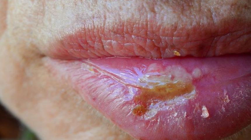 Aft ile uçuk arasındaki farklar nelerdir? Uçuk ve aft nedenleri