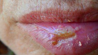 Aft ile uçuk arasındaki farklar nelerdir? Uçuk ve aft nedenleri