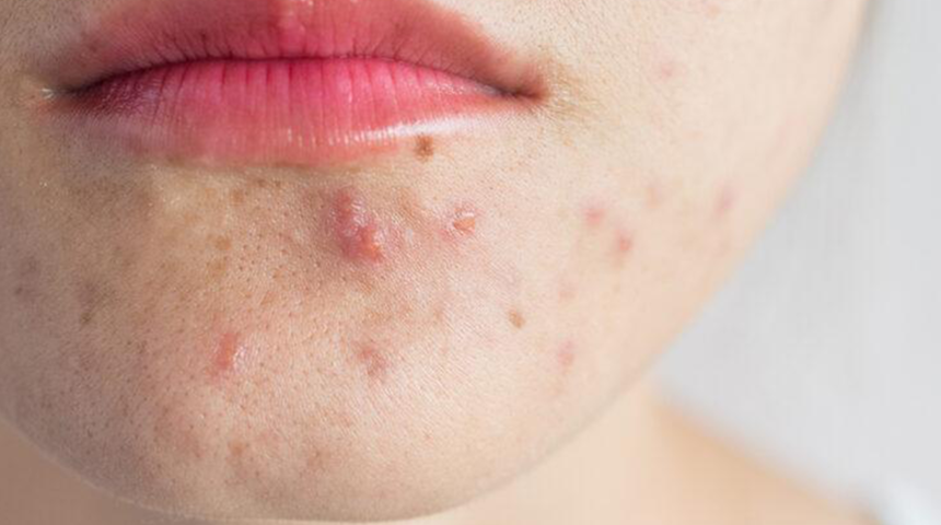 Amazon yağından sivilce ilacı yapıldı