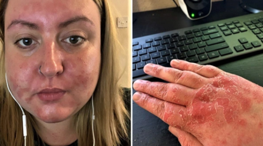 Sedef hastalığı ile mücadele eden kadın cildinden utanıyor: Bana iğrenç diyorlar