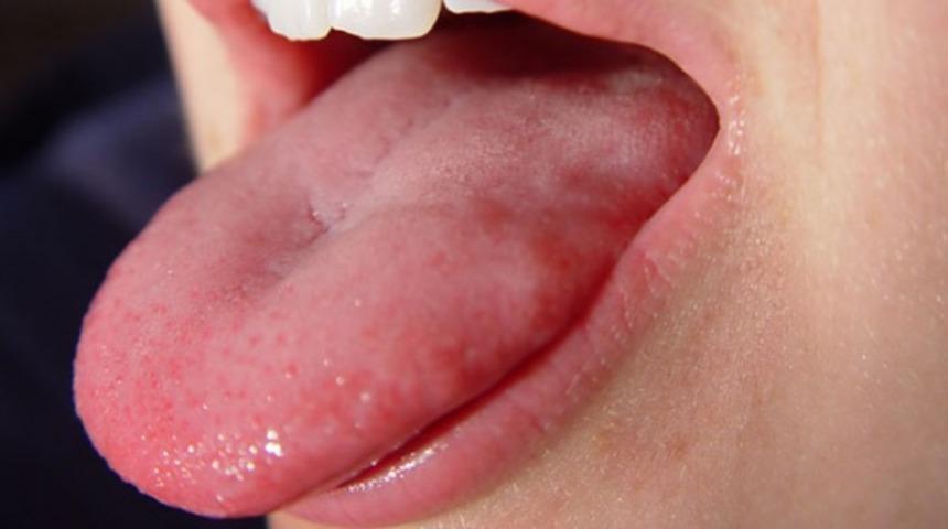 Dilinize bakarak hastalığı anlayın