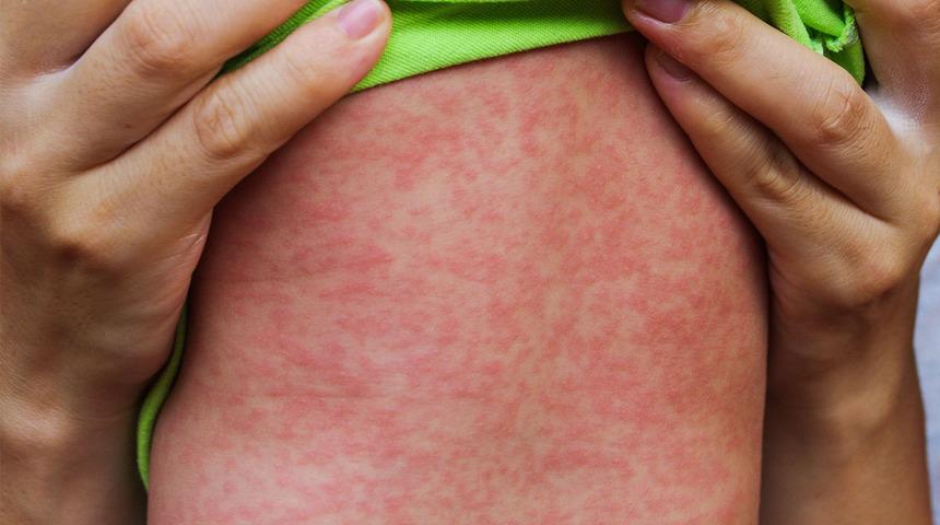 Kızamık hastalığına dikkat