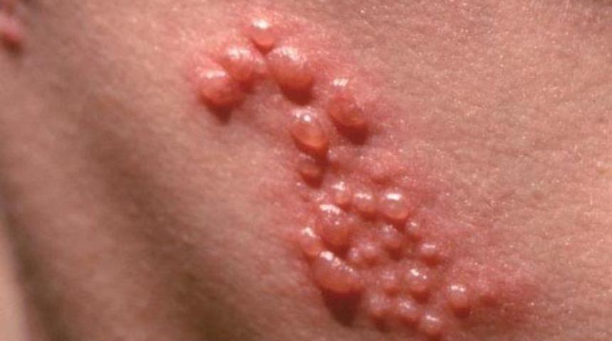 Zona nedir? Ni&ccedil;in tekrarlar? 