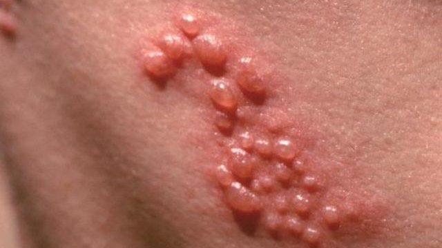 Zona nedir? Niçin tekrarlar? 