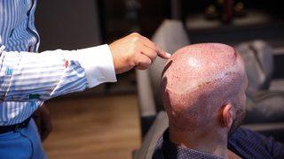 Uzman olmayanlar saç ekemeyecek