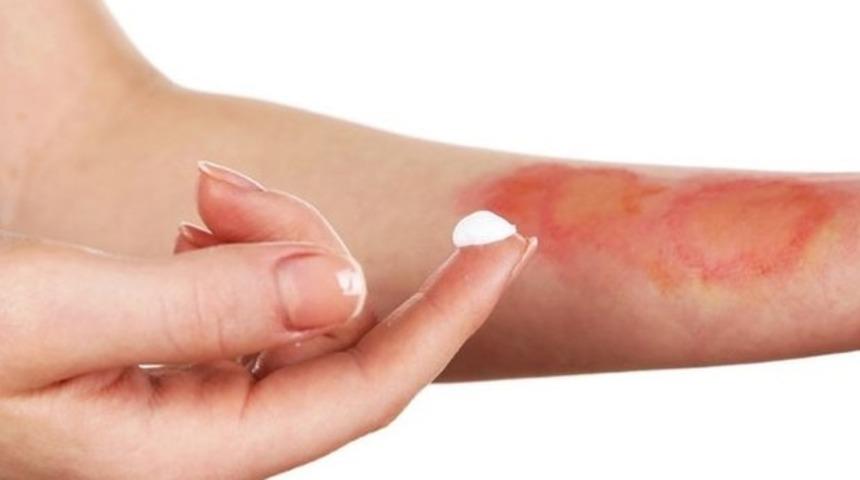 Yanıkların en büyük nedeni elektrik  