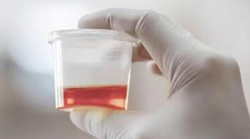 İdrarda kan görülmesi