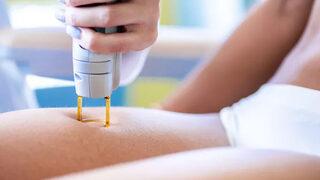 Lazer nedir, nasıl yapılır?