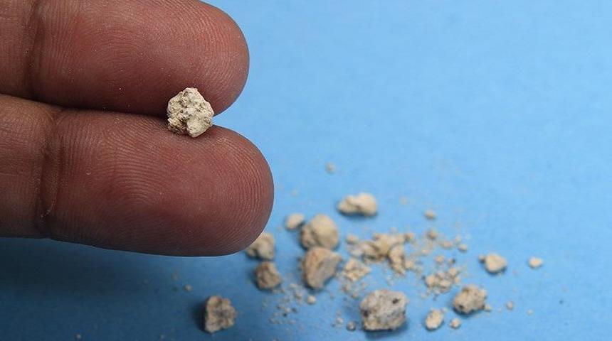 Taş hastalıklarının görülme sıklığı artıyor