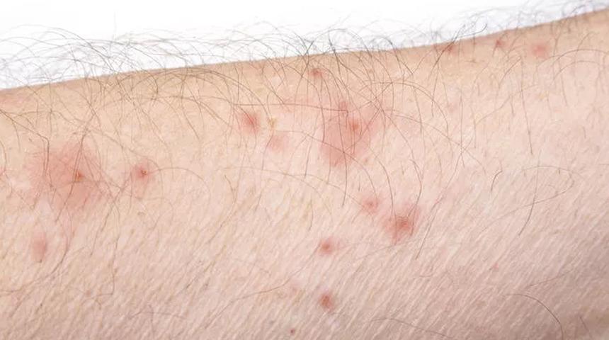 Uyuz, insanlık tarihinin eski hastalığı 