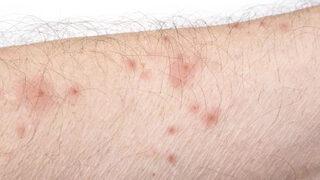 Uyuz, insanlık tarihinin eski hastalığı 