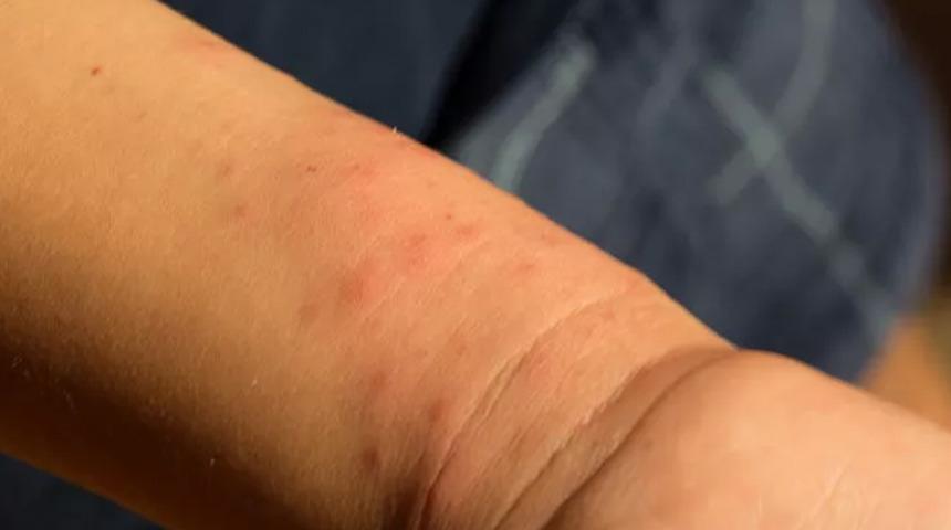 Besin alerjisi nasıl anlaşılır? 