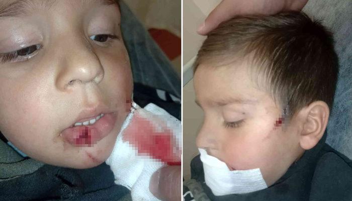 Kastamonu'da köpek saldırısına uğrayan 3 yaşındaki çocuk ölümden döndü
