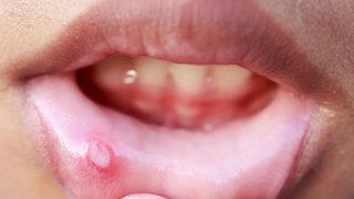 Ağız yaraları 1 haftada geçmiyorsa dikkat! 