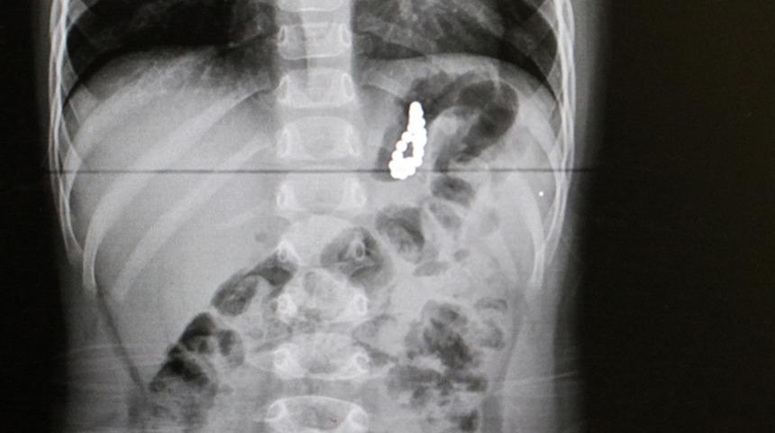 Hastaneye gidince ortaya çıktı: Pandemiyle birlikte çocuklarda yabancı cisim yutma vakası arttı