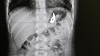 Hastaneye gidince ortaya çıktı: Pandemiyle birlikte çocuklarda yabancı cisim yutma vakası arttı