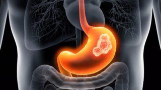 Uzmanlardan mide kanseri uyarısı