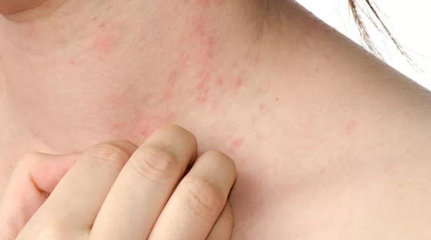 Lenfoma kanseri hakkında ne biliyoruz?