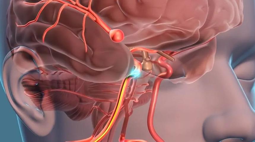 Damarlarda dolaşan tehlike: Anevrizma