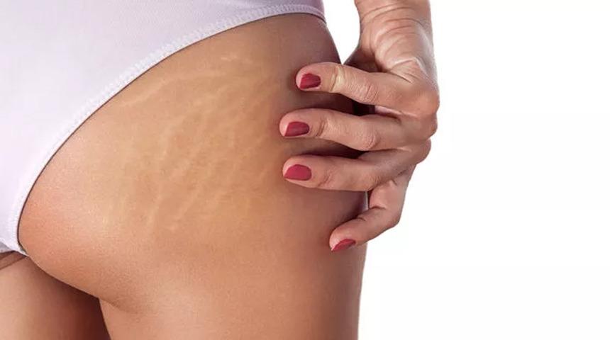 Selülite karşı 'mezoterapi'