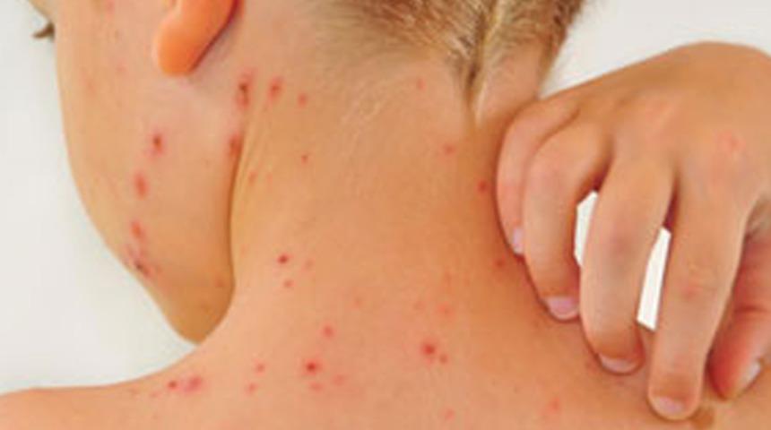 DSÖ: Dünyada kızamıktan ölümler yüzde 68 azaldı