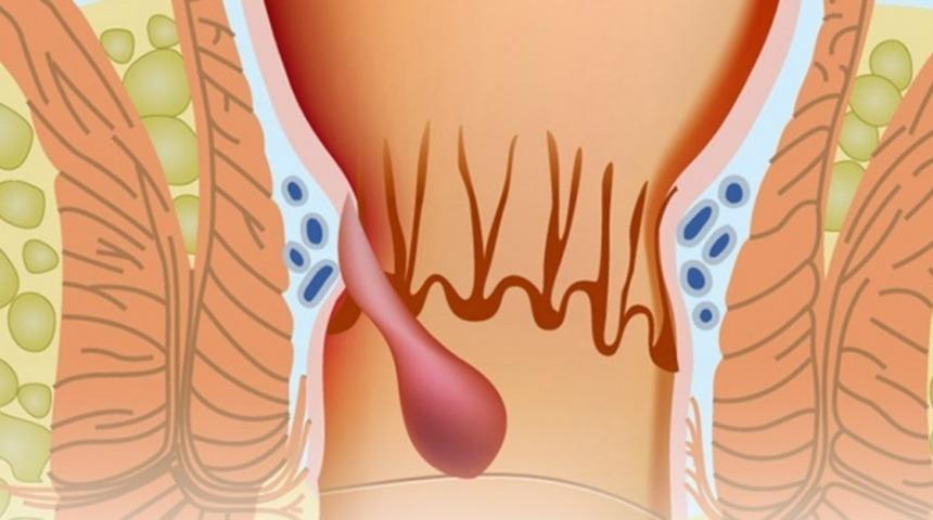 Kış aylarında 'hemoroid'iniz azmasın