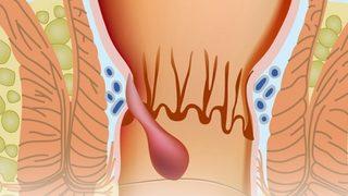 Kış aylarında 'hemoroid'iniz azmasın