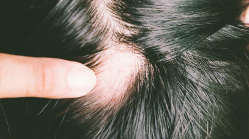 Şok diyetler saç döküyor